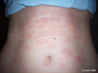 pytiriasis